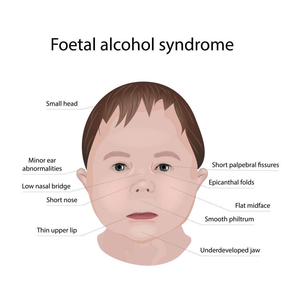 Syndrome De Lalcoolisation Foetale Saf Les Trésors En éducation Spécialisée 